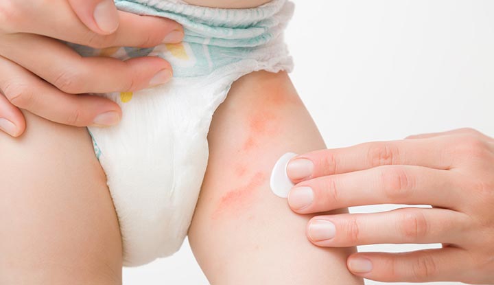 How Do You Know If Diaper Rash is Yeast