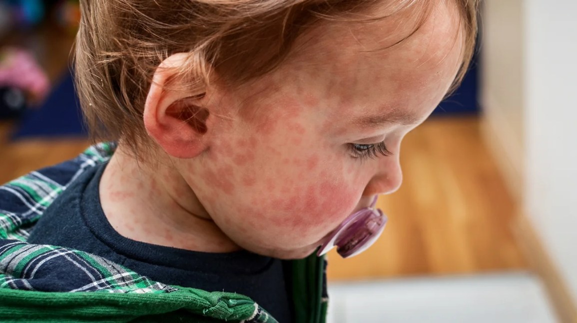 How Do You Know If Your Baby Has Food Allergy